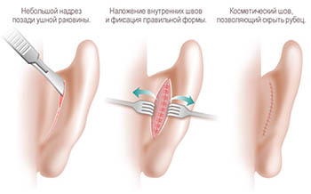 Отопластика в Москве